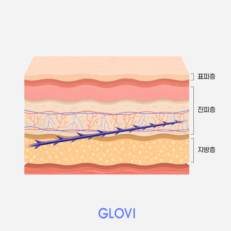 실리프팅 유지기간, 실리프팅 주기 실제로 얼마나 갈까? 관련 이미지 2