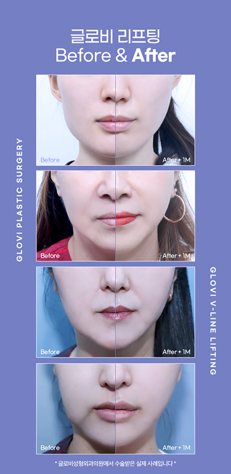 실리프팅 후 바로 일상생활 가능할까? 관련 이미지 7