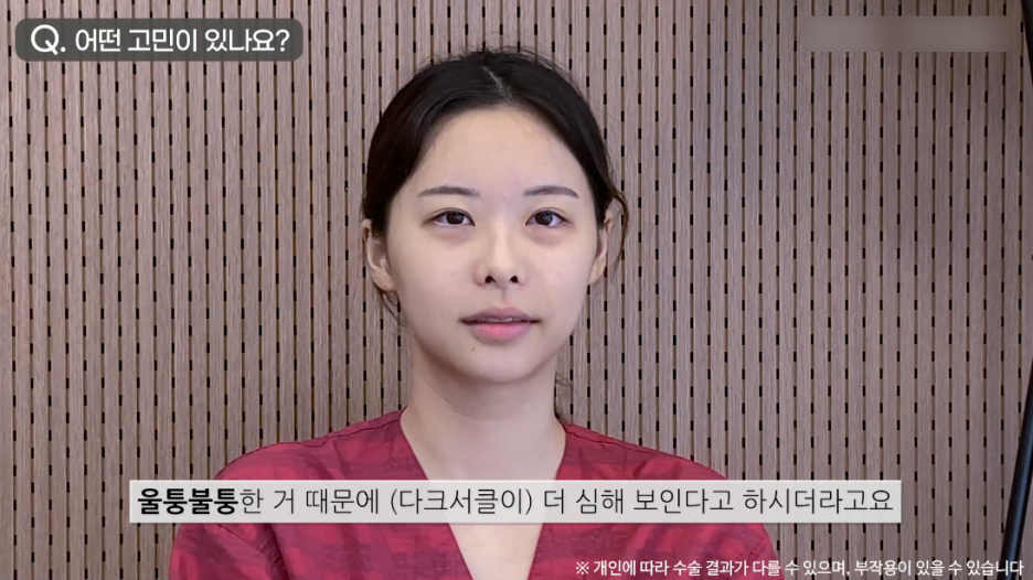 눈밑지방재배치수술 리얼후기 1탄｜눈밑다크써클 개선 시작! 관련 이미지 5