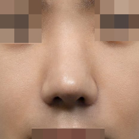 콧볼축소 부작용? 절개 위치부터 확인하세요 관련 이미지 7