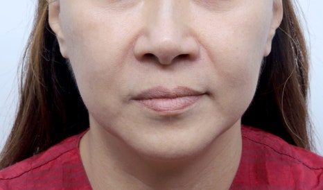 Thread-Lifting Swelling: Tips for Managing Swelling for a Quick Return to Daily Life image 8