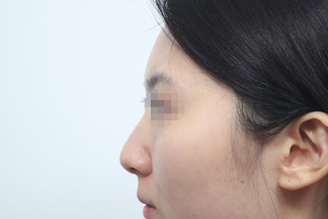 First-Time Rhinoplasty: How to Create a Natural Change Without Going Too Far image 5