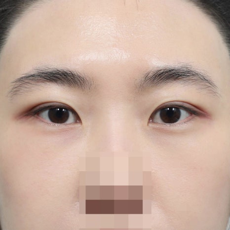 How to Apply Cold Compresses After Double Eyelid Surgery: Proper Swelling Care Guidelines image 7