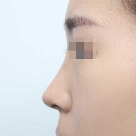 중년 코성형, 나이가 많으면 수술이 위험할까요? 관련 이미지 6