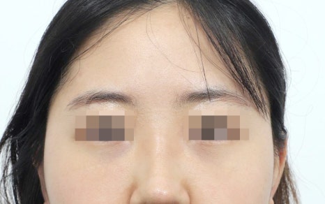 Lower Eyelid Fat Repositioning Side Effects: What You Should Know to Help Prevent Them image 3