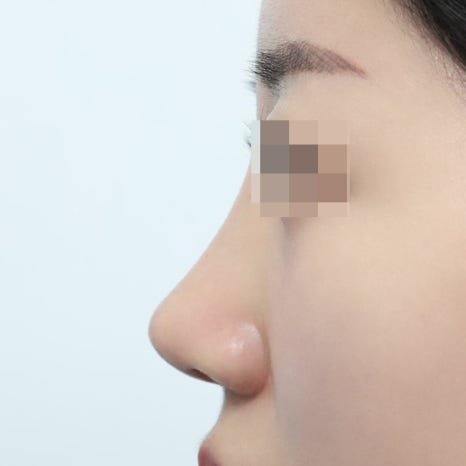 코재수술 시기 최소 6개월을 기다려야 하는 이유 관련 이미지 11