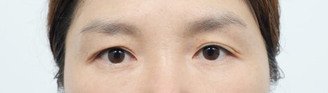 Upper Blepharoplasty: How to Improve Covered, Drooping Eyelids image 3