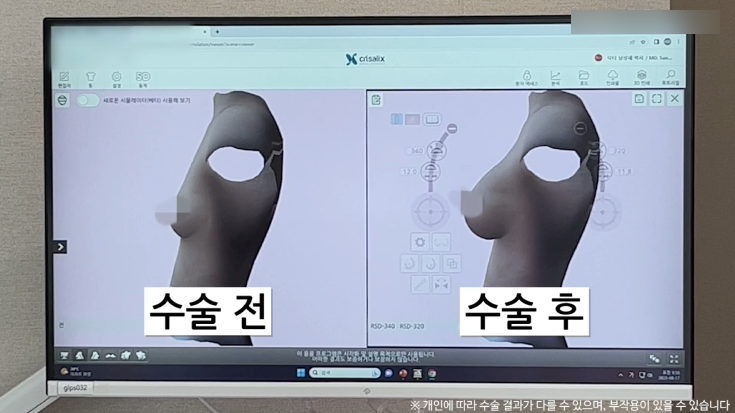 모티바가슴성형 리얼후기 1탄｜글로비성형외과의원 관련 이미지 11