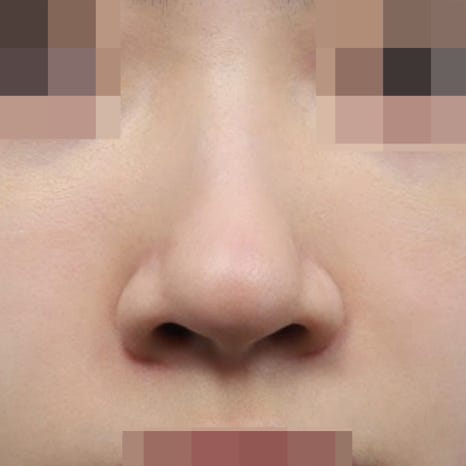 콧볼축소 부작용? 절개 위치부터 확인하세요 관련 이미지 4
