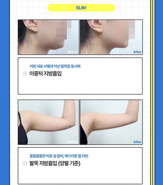 [글로비성형외과] 여름방학 이벤트! 눈&middot;코&middot;바디 라인 혜택 정리 관련 이미지 6