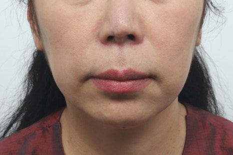 인중축소 잘하는곳, 입술이 어색해지는 부작용을 낮추는 수술법 관련 이미지 5