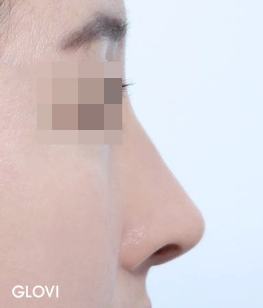 압구정 코재수술, 실패의 원인부터 분석해야 하는 이유 관련 이미지 6