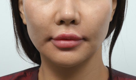 Thread Lifting in Sinsa-dong: Why You Shouldn’t Have It Done Exactly the Same Way as Before image 5