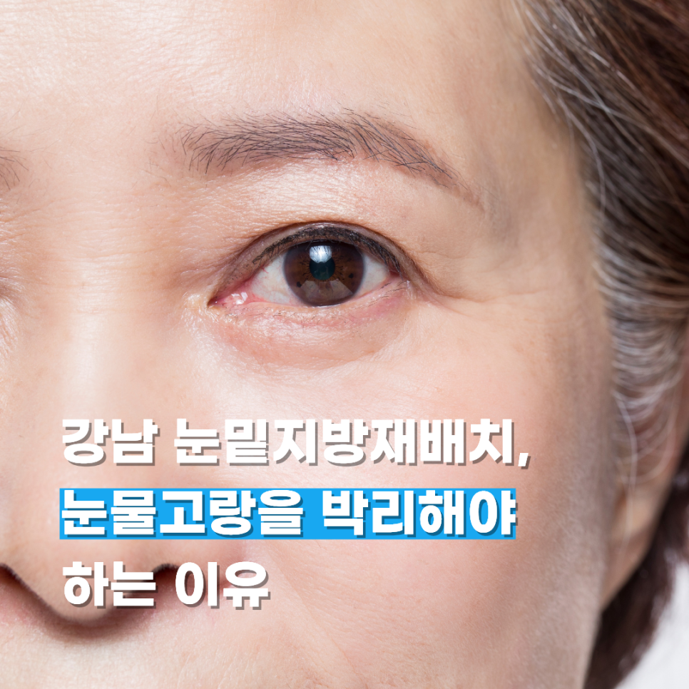 강남 눈밑지방재배치, 눈물고랑을 박리해야 하는 이유 관련 이미지 1