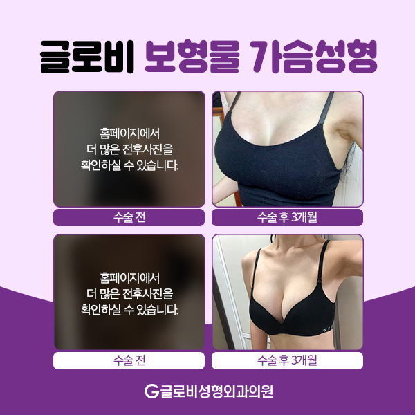모티바가슴성형 보형물에 대해 알아보자 관련 이미지 9