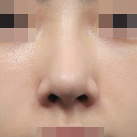 콧볼축소 부작용? 절개 위치부터 확인하세요 관련 이미지 5