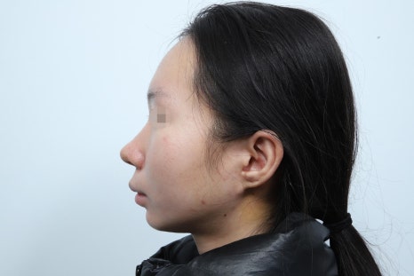 Autologous Dermal Graft Rhinoplasty: Read This If You’re Concerned About Resorption image 5