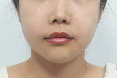 Philtrum Reduction for Middle-Aged Patients: Correcting the Lengthening Area Between the Nose and Upper Lip with Age image 3