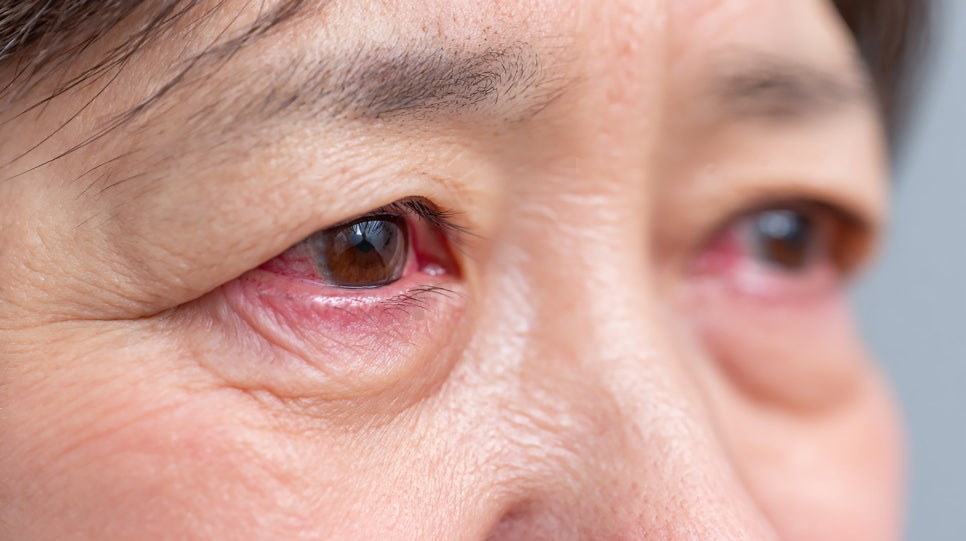 중년 눈밑지방재배치, 나이 들수록 효과가 다른 이유가 있습니다 관련 이미지 2