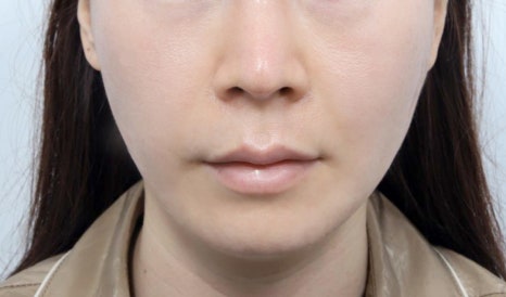 Thread Lifting and Facelift Surgery: Which Procedure Is Right for Me? image 3