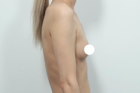 Apgujeong Breast Augmentation: Know This One Thing Before You Search image 2