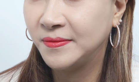 Why the Surgeon Matters More Than the Price When Choosing a Clinic Skilled in Thread Lifting image 5