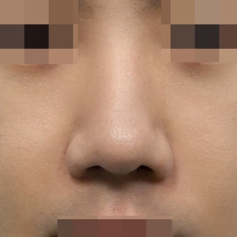 콧볼축소 부작용? 절개 위치부터 확인하세요 관련 이미지 6