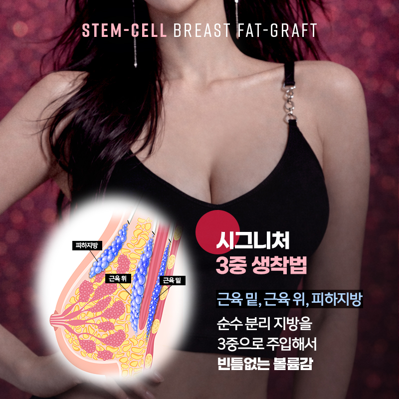 줄기세포가슴지방이식, 생착률&middot;안전성&middot;결과까지 관련 이미지 4
