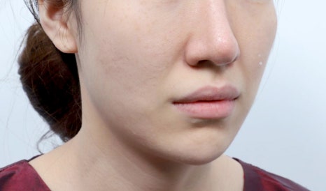 Thread-Lifting Swelling: Tips for Managing Swelling for a Quick Return to Daily Life image 4