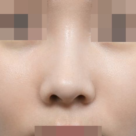 콧볼축소 부작용? 절개 위치부터 확인하세요 관련 이미지 9