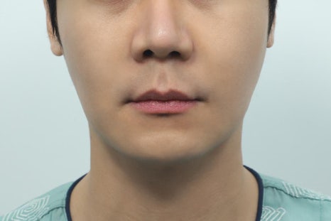 Philtrum Reduction Review: The Real Story No One Tells You image 5