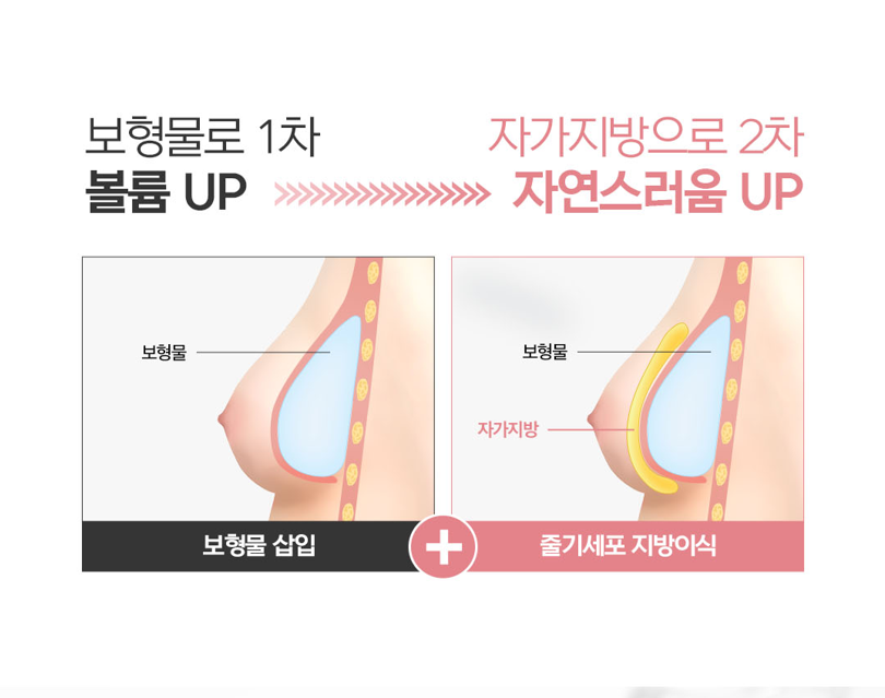 Comparing Breast Fat Grafting and Implants: Differences and Which Option Is Right for Me image 7
