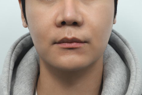 Philtrum Reduction Review: The Real Story No One Tells You image 6