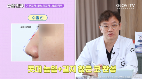 매부리코 긴코 코성형 리뷰, 글로비 3D 피팅코수술 관련 이미지 4