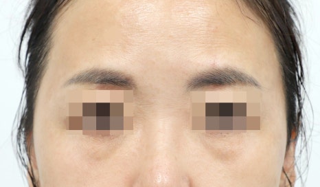 Lower Eyelid and Upper Eyelid Surgery: Should They Be Performed Together as You Age? image 8