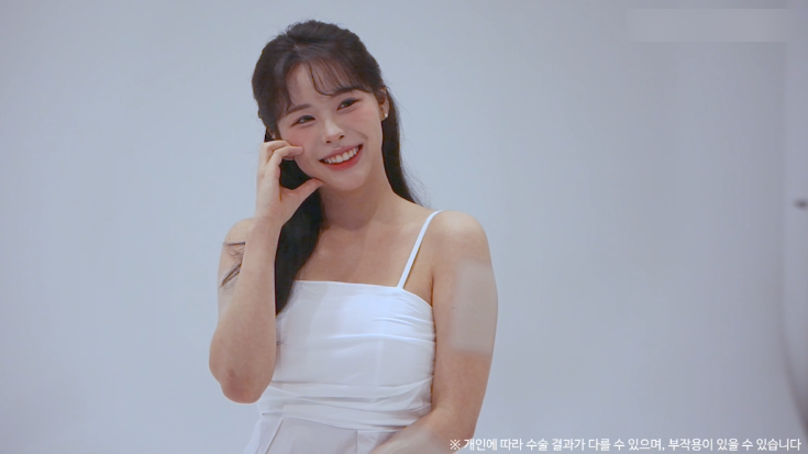 눈밑지방재배치수술 리얼후기 2탄｜수술 한달 후 경과확인! 관련 이미지 15