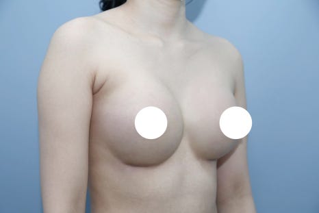 절벽가슴수술, 보형물만으로 될까요? 모양 교정이 따로 필요한 이유 관련 이미지 4