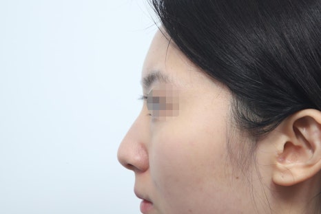 Autologous Dermal Graft Rhinoplasty: Read This If You’re Concerned About Resorption image 2