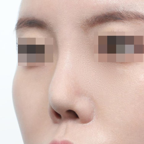 Can Implant-Free Rhinoplasty Really Look Natural Without a Prosthesis? image 4