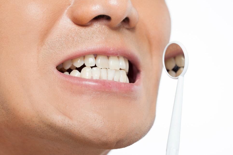 남자 인중축소, 받아도 되는 케이스인지부터 확인하세요 관련 이미지 7