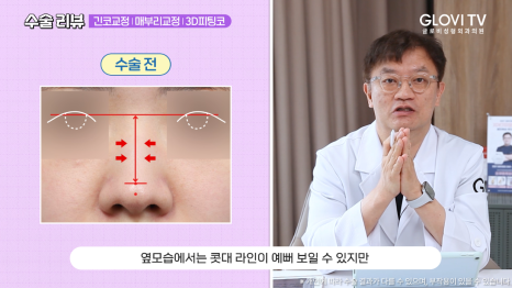 매부리코 긴코 코성형 리뷰, 글로비 3D 피팅코수술 관련 이미지 5