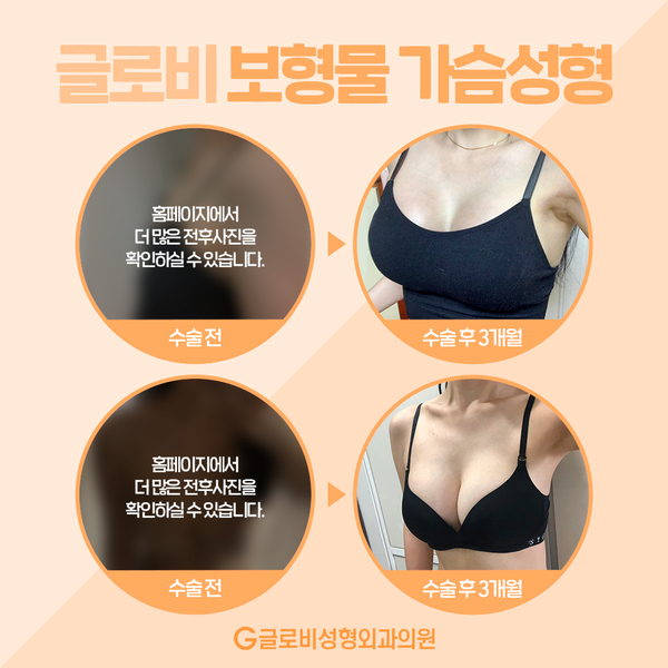 가슴성형비용, 모티바 멘토 세빈 어떻게 다를까 관련 이미지 6