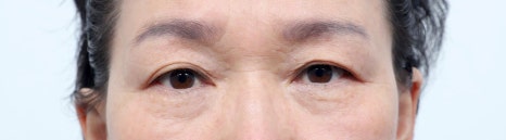 Double Eyelid Surgery in Middle Age: Improving Drooping Eyelids and Differences from Upper Blepharoplasty image 8
