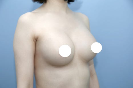 구형구축 재수술, 딱딱해진 가슴을 다시 부드럽게 되돌리는 법 관련 이미지 3