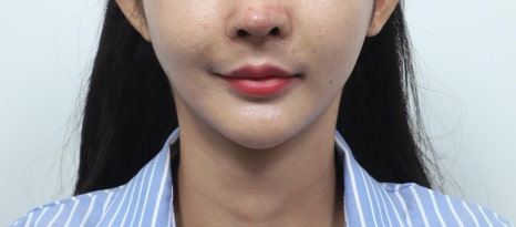 실리프팅 후 관리법, 효과를 오래 유지하는 습관 관련 이미지 5