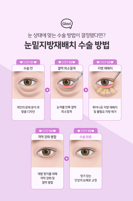 눈밑지방재배치수술 눈밑지란? 눈밑지 붓기 부작용은? 관련 이미지 3