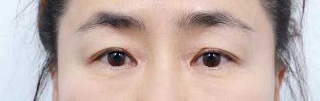 Middle-Aged Eye Surgery: Understanding Eye Surgery Options by Age image 7