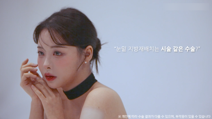 눈밑지방재배치수술 리얼후기 2탄｜수술 한달 후 경과확인! 관련 이미지 11