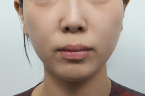 Philtrum Reduction Review: The Real Story No One Tells You image 7