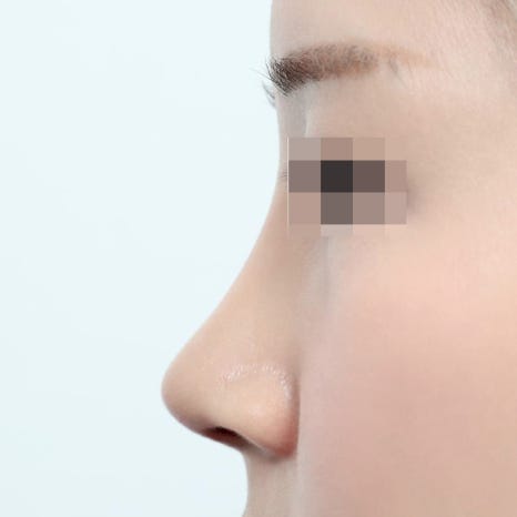 The Process of Autologous Rib Cartilage Rhinoplasty and Its Advantages and Disadvantages Compared with Implants image 6